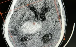 Xuất huyết não do tăng huyết áp không được phát hiện