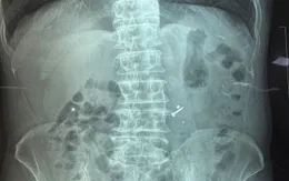 Nuốt đinh vào bụng khi đang sửa chữa trần nhà