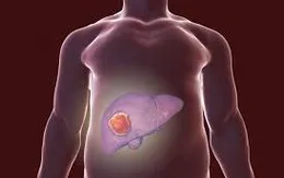 Gan nhiễm mỡ do rượu bia ngày Tết: Đừng để cuộc vui thành nỗi lo sức khỏe