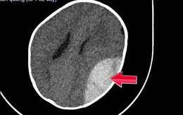 Trẻ 8 tháng tuổi phải phẫu thuật sọ não do ngã xe tròn