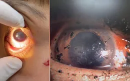 Nhiều ca chấn thương mắt do pháo nổ dịp Tết