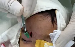 Cảnh báo nguy cơ nhiễm trùng do bỏ sót dị vật sau chấn thương ở trẻ