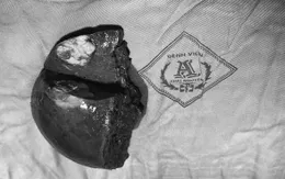 Cắt khối u gan lớn bằng kỹ thuật hiện đại, bệnh nhân phục hồi sau 1 tuần