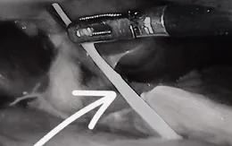 Áp xe ruột thừa do xương cá đâm thủng