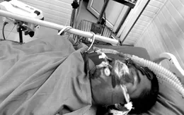 Cứu sống ngoạn mục bệnh nhân động kinh ngừng tuần hoàn do bỏng nặng