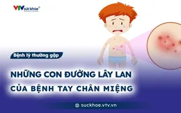 Những con đường lây lan của bệnh tay chân miệng