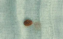 Cảnh giác sỏi niệu quản ở trẻ