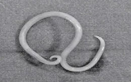 Thiếu niên bị thủng ruột do giun đũa