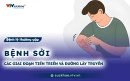 Bệnh sởi: Các giai đoạn tiến triển và đường lây truyền