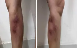 Cảnh báo biến chứng nguy hiểm khi tiêm filler làm thẳng chân tại nhà