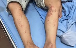 Ghi nhận ca viêm mao mạch dị ứng ở trẻ