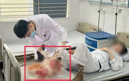 Suýt mất chân vì đắp lá chữa bỏng