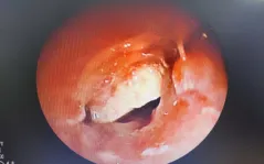 Gắp hạt hạnh nhân bít kín phế quản trẻ