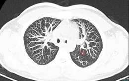 7 năm sau mổ ung thư tuyến giáp, phát hiện nghi di căn phổi