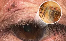 Hi hữu: Phát hiện rận mu ký sinh trên mí mắt