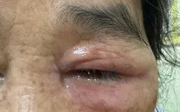 Cảnh báo viêm kết mạc do độc tố côn trùng