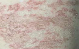 Nguyên nhân gây ngứa kéo dài 2 năm, trên da xuất hiện các vệt dài