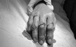 Vi phẫu nối thành công 4 ngón tay đứt lìa