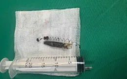 Lấy dị vật bút bi tồn tại... 13 năm trong vùng thái dương