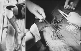 Tai nạn từ máy mài: Cảnh báo từ một ca chấn thương nặng