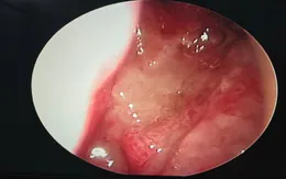 Ù tai kéo dài có thể cảnh báo ung thư vòm họng