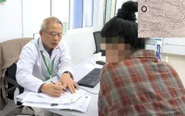 Viêm da mặt do ký sinh trùng Demodex