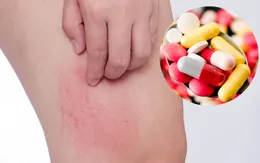 Dị ứng thời tiết mùa xuân: Dùng thuốc thế nào cho đúng?