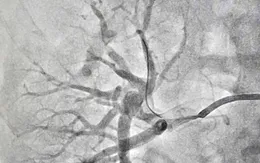 Đau bụng tưởng viêm ruột thừa, phát hiện tắc động mạch thận hiếm gặp