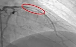 Can thiệp "giờ vàng" cứu sống bệnh nhân nhồi máu cơ tim nguy kịch