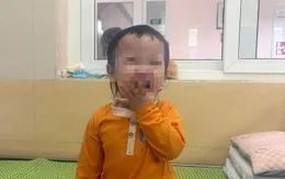 Bệnh tay chân miệng có thể khởi phát không điển hình, dễ bỏ sót ở trẻ nhỏ