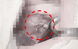 Nguy hiểm: Dị vật đâm sâu vào hầu họng ở trẻ nhỏ