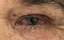 Đỏ mắt kéo dài, cảnh báo viêm màng bồ đào nguy hiểm