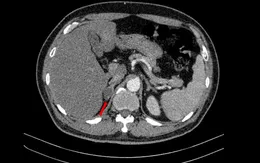 Hiếm gặp: Bệnh nhân mắc đồng thời ung thư phổi và tuyến tiền liệt