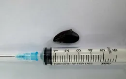 Ho kéo dài 4 tháng, phát hiện hạt hồng xiêm mắc trong phế quản