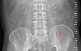 Phát hiện nhiều ký sinh trùng trong cơ thể người bệnh thích ăn gỏi cá