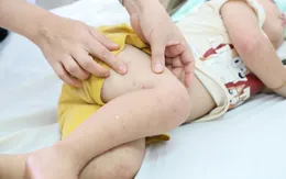 Diễn biến bệnh tay chân miệng: Cảnh báo gia tăng số ca nặng do nhiễm chủng EV71