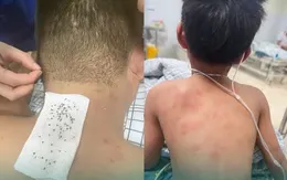Hai cha con nguy kịch vì bị hàng trăm con ong đốt