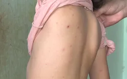 Cẩn trọng biến chứng nguy hiểm của bệnh thủy đậu khi giao mùa