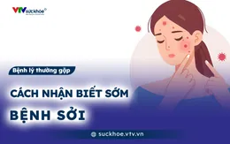 Cách nhận biết sớm bệnh sởi