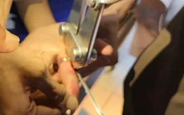 Cẩn trọng: Tai nạn đeo nhẫn gây chèn ép ngón tay ở trẻ