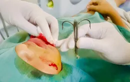 Lưỡi câu móc vào mặt bé trai khi đi câu cá