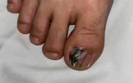 Vệt đen dưới móng có thể là dấu hiệu ung thư nguy hiểm