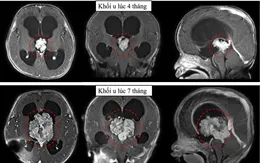 Cứu bé 7 tháng tuổi có khối u não lớn