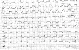 Cứu sống bệnh nhân nhồi máu cơ tim nguy kịch