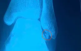 Lấy mảnh xương kẹt trong khớp cổ chân bằng nội soi