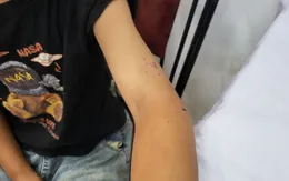 Liên tiếp chó nghi dại tấn công người dân, cảnh báo nguy cơ bệnh dại