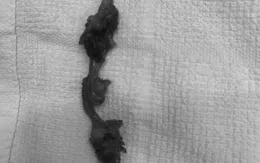 Phát hiện ca nang niệu rốn hiếm gặp