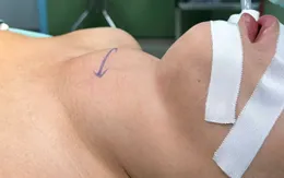 Cắt bỏ bướu giáp đè ép đường thở người bệnh