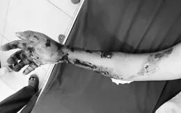 Cảnh báo nguy cơ khi xử trí bỏng muộn