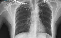 Hy hữu: Ca gãy cùng lúc hai xương đòn sau tai nạn giao thông